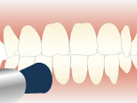 STEP3歯と歯の間の清掃・研磨